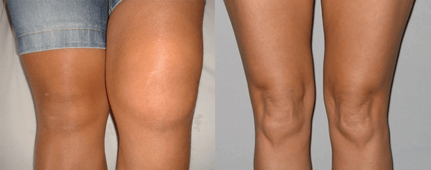 Iskustvo korištenja kapsula ulja konoplje prije i poslije uporabe od Eve